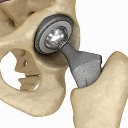 Artroplastia Do Quadril