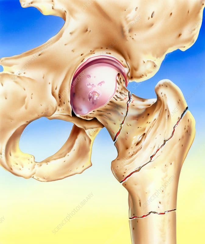 Tratamento de Fraturas