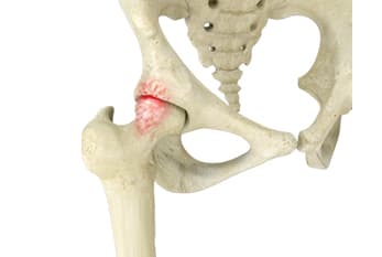 Impacto Femoroacetabular (IFA) | Patologias | Dr. Roni Serra
